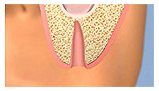 SINUS_LIFT1
