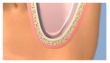 SINUS_LIFT2
