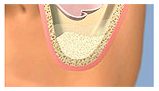 SINUS_LIFT3