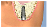 SINUS_LIFT4