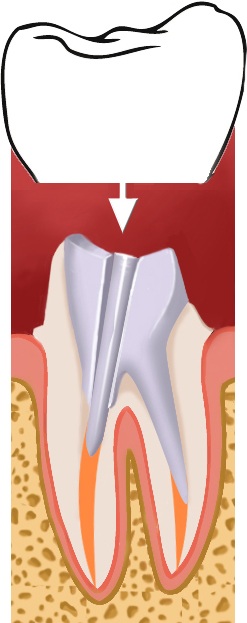 inlay-core