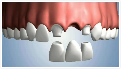 manque_une_dent