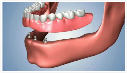 prothese_amovible_3_implants