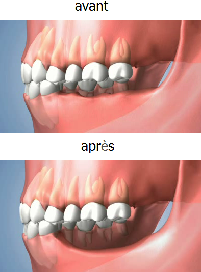 resorption_osseuse_2