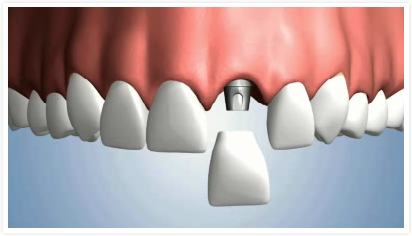 un_implant